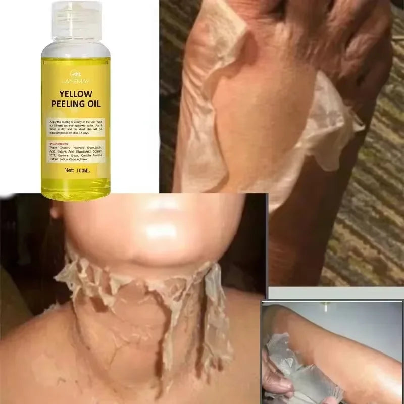 Extra Strong Yellow Peeling Oil – Skin Whitening & Exfoliating Treatment